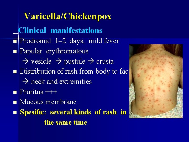 Varicella/Chickenpox Clinical manifestations n n n Prodromal: 1– 2 days, mild fever Papular erythromatous