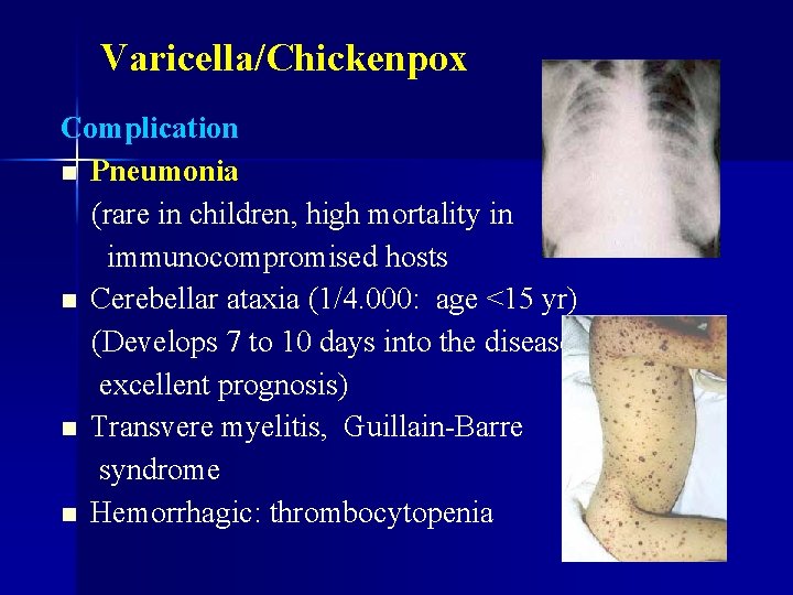 Varicella/Chickenpox Complication n Pneumonia (rare in children, high mortality in immunocompromised hosts n Cerebellar