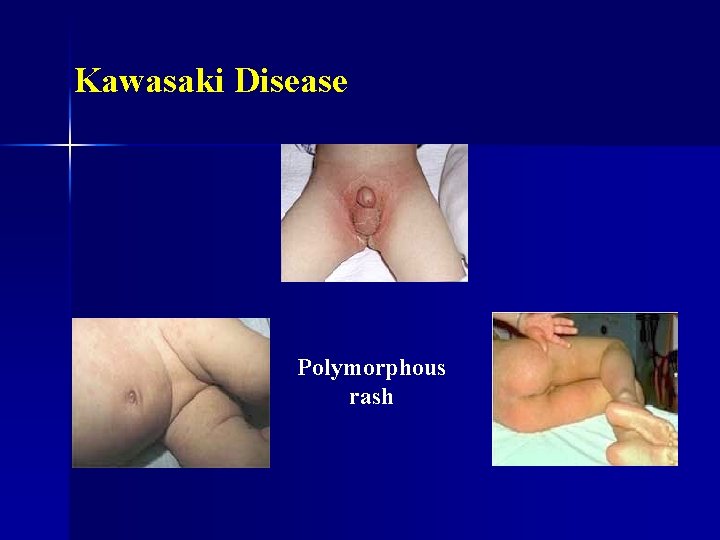 Kawasaki Disease Polymorphous rash 