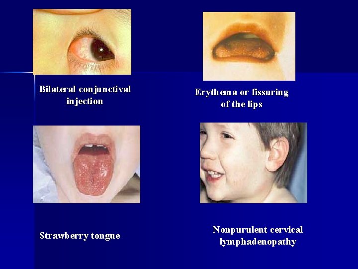 Bilateral conjunctival injection Strawberry tongue Erythema or fissuring of the lips Nonpurulent cervical lymphadenopathy