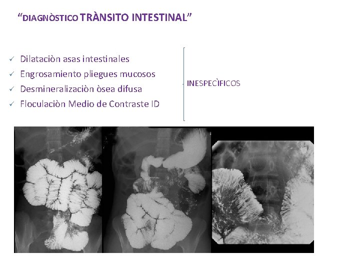 “DIAGNÒSTICO TRÀNSITO INTESTINAL” ü Dilataciòn asas intestinales ü Engrosamiento pliegues mucosos Desmineralizaciòn òsea difusa “DIAGNÒSTICO TRÀNSITO INTESTINAL” ü Dilataciòn asas intestinales ü Engrosamiento pliegues mucosos Desmineralizaciòn òsea difusa