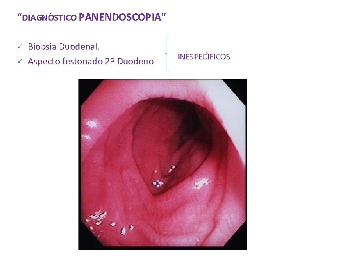 “DIAGNÒSTICO PANENDOSCOPIA” ü Biopsia Duodenal. ü Aspecto festonado 2 P Duodeno INESPECÌFICOS “DIAGNÒSTICO PANENDOSCOPIA” ü Biopsia Duodenal. ü Aspecto festonado 2 P Duodeno INESPECÌFICOS