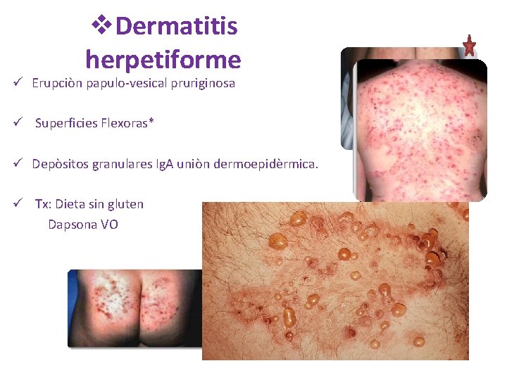 v. Dermatitis herpetiforme ü Erupciòn papulo-vesical pruriginosa ü Superficies Flexoras* ü Depòsitos granulares Ig. v. Dermatitis herpetiforme ü Erupciòn papulo-vesical pruriginosa ü Superficies Flexoras* ü Depòsitos granulares Ig.