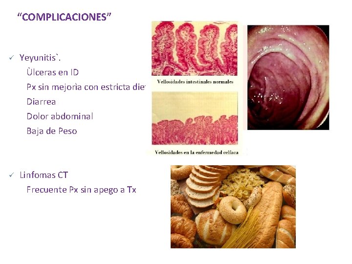 “COMPLICACIONES” ü Yeyunitis`. Ùlceras en ID Px sin mejorìa con estricta dieta Diarrea Dolor “COMPLICACIONES” ü Yeyunitis`. Ùlceras en ID Px sin mejorìa con estricta dieta Diarrea Dolor