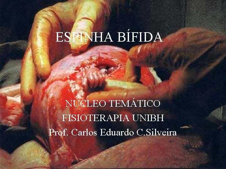 ESPINHA BÍFIDA NÚCLEO TEMÁTICO FISIOTERAPIA UNIBH Prof. Carlos Eduardo C. Silveira 