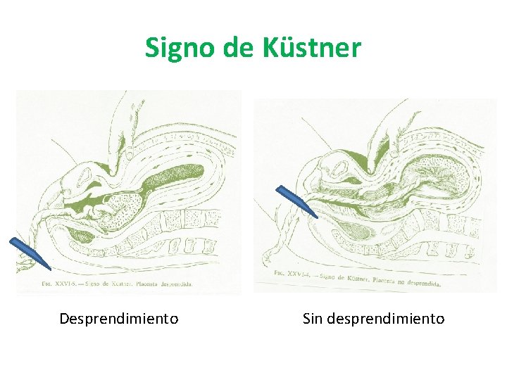 Signo de Küstner Desprendimiento Sin desprendimiento Signo de Küstner Desprendimiento Sin desprendimiento