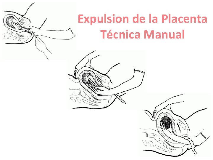 Expulsion de la Placenta Técnica Manual Expulsion de la Placenta Técnica Manual