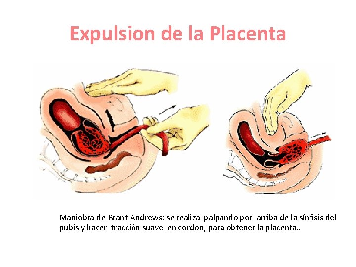 Expulsion de la Placenta Maniobra de Brant-Andrews: se realiza palpando por arriba de la Expulsion de la Placenta Maniobra de Brant-Andrews: se realiza palpando por arriba de la