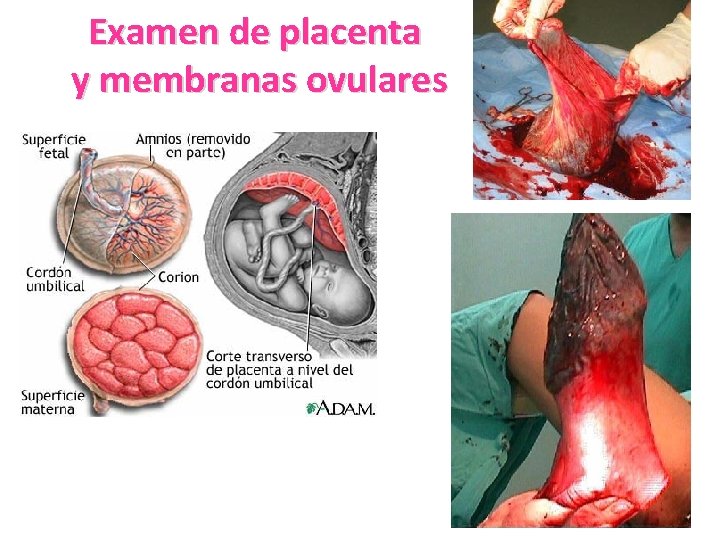 Examen de placenta y membranas ovulares Examen de placenta y membranas ovulares