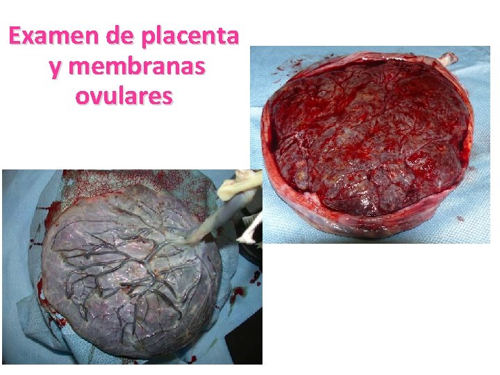 Examen de placenta y membranas ovulares Examen de placenta y membranas ovulares