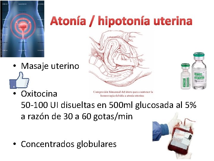 Atonía / hipotonía uterina • Masaje uterino • Oxitocina 50 -100 UI disueltas en Atonía / hipotonía uterina • Masaje uterino • Oxitocina 50 -100 UI disueltas en