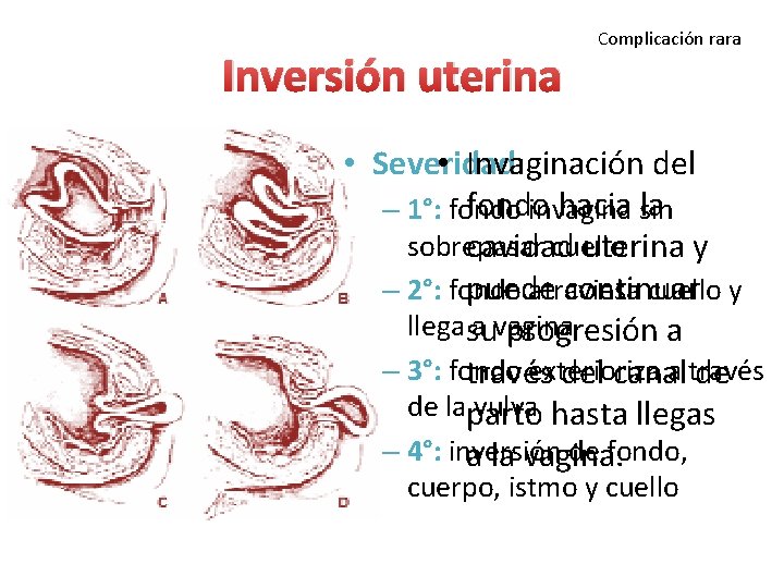 Inversión uterina Complicación rara • Severidad: • Invaginación del fondo hacia sin la – Inversión uterina Complicación rara • Severidad: • Invaginación del fondo hacia sin la –