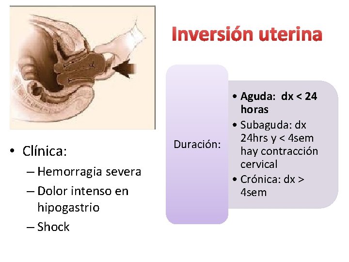 Inversión uterina • Clínica: – Hemorragia severa – Dolor intenso en hipogastrio – Shock Inversión uterina • Clínica: – Hemorragia severa – Dolor intenso en hipogastrio – Shock