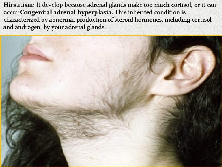 Hirsutism: It develop because adrenal glands make too much cortisol, or it can occur