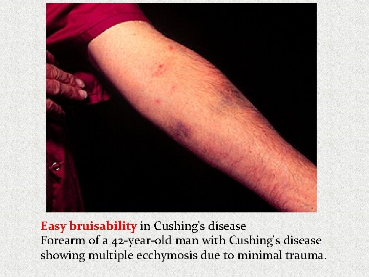 Easy bruisability in Cushing's disease Forearm of a 42 -year-old man with Cushing's disease