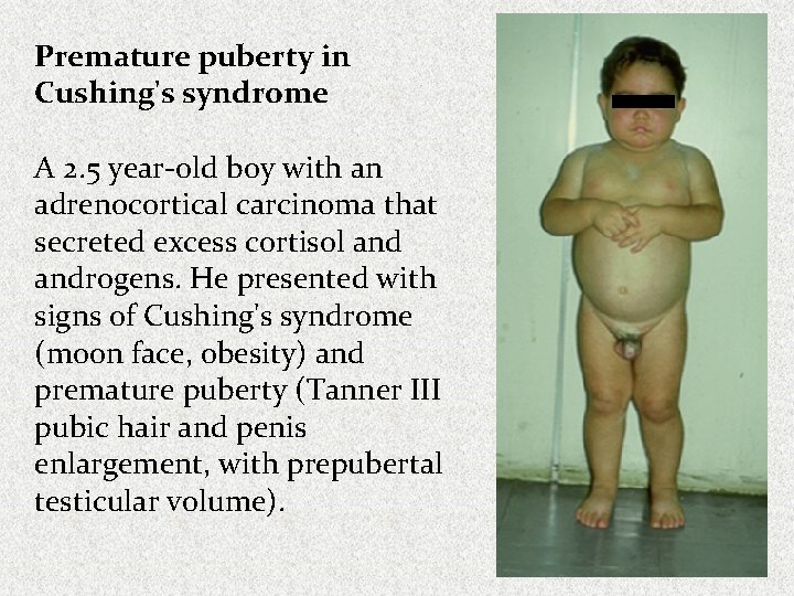 Premature puberty in Cushing's syndrome A 2. 5 year-old boy with an adrenocortical carcinoma