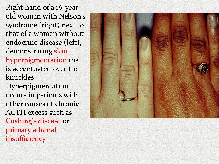 Right hand of a 16 -yearold woman with Nelson's syndrome (right) next to that