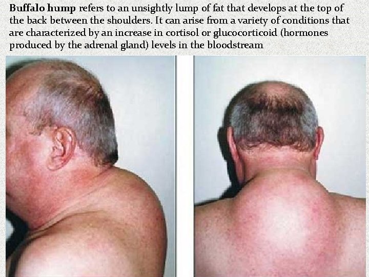 Buffalo hump refers to an unsightly lump of fat that develops at the top