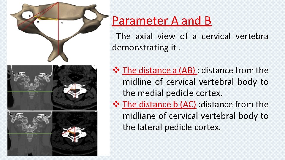Parameter A and B The axial view of a cervical vertebra demonstrating it. v