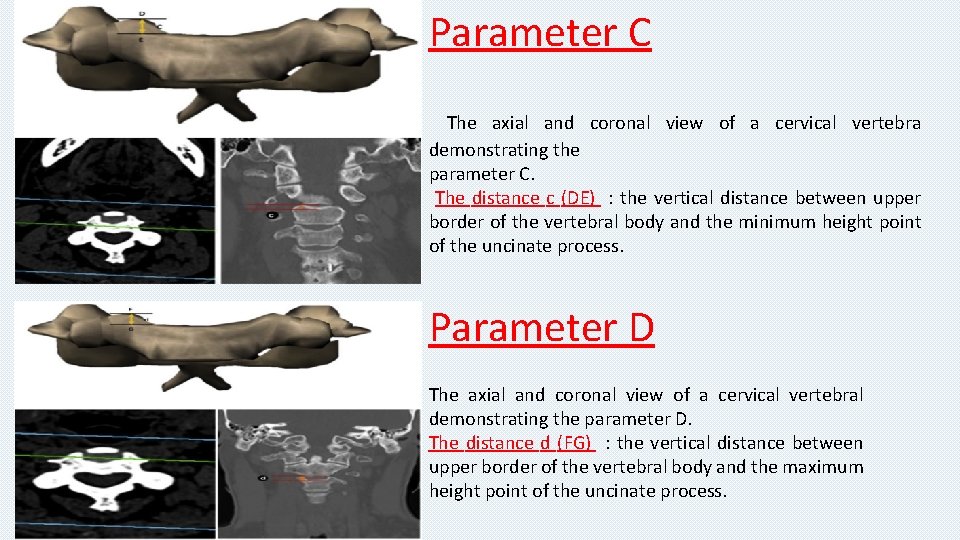 Parameter C The axial and coronal view of a cervical vertebra demonstrating the parameter