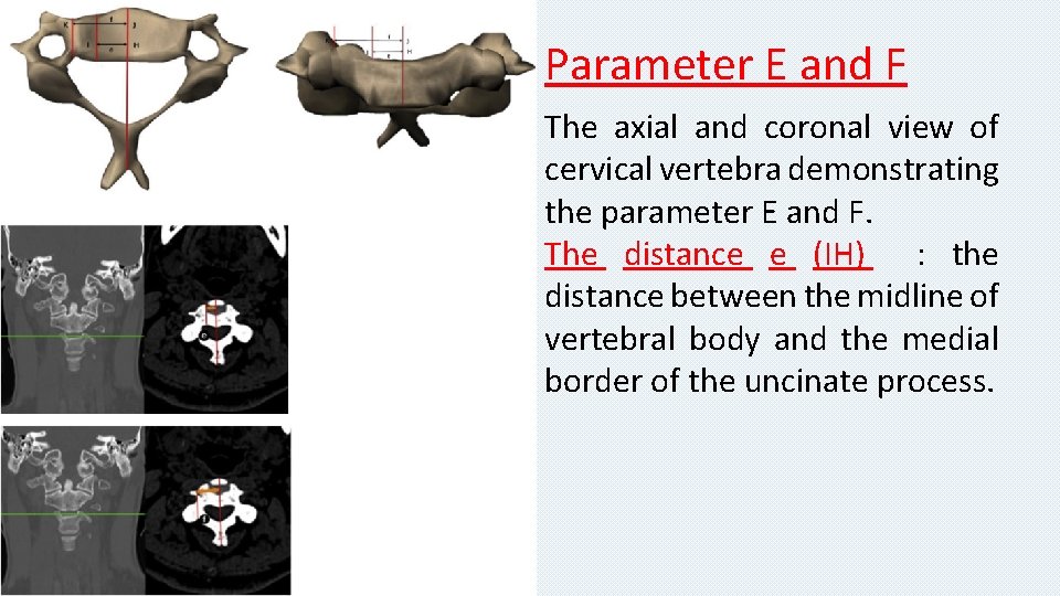 Parameter E and F The axial and coronal view of cervical vertebra demonstrating the