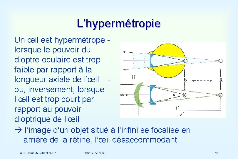 L’hypermétropie Un œil est hypermétrope lorsque le pouvoir du dioptre oculaire est trop faible