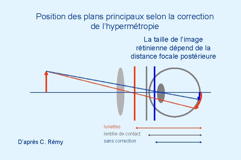 Position des plans principaux selon la correction de l’hypermétropie La taille de l’image rétinienne