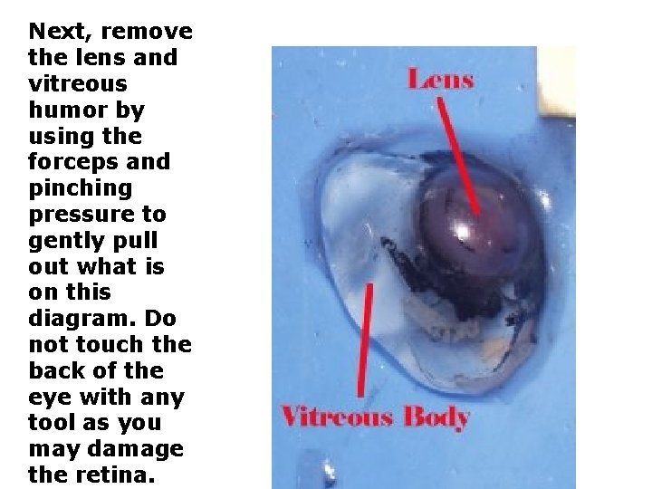 Next, remove the lens and vitreous humor by using the forceps and pinching pressure