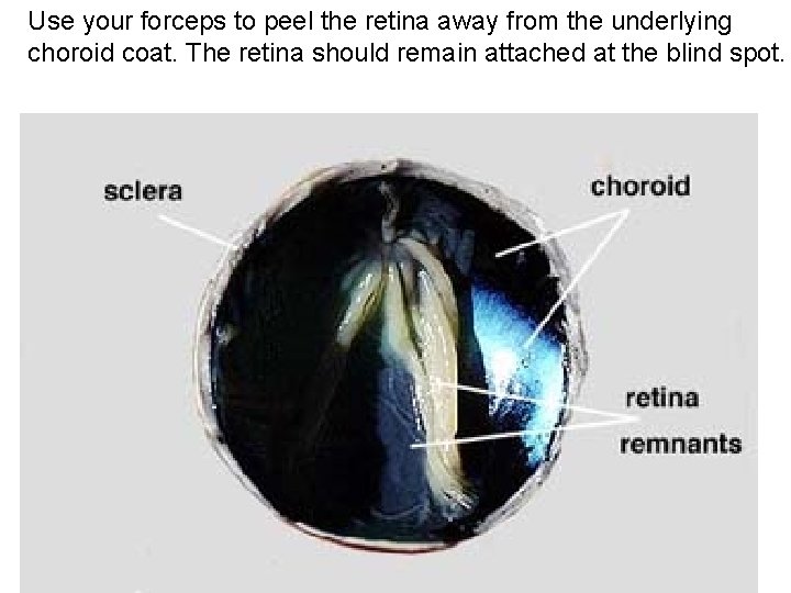 Use your forceps to peel the retina away from the underlying choroid coat. The