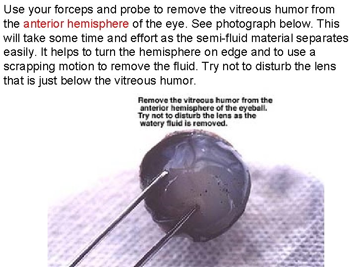 Use your forceps and probe to remove the vitreous humor from the anterior hemisphere