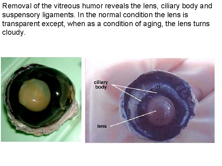 Removal of the vitreous humor reveals the lens, ciliary body and suspensory ligaments. In