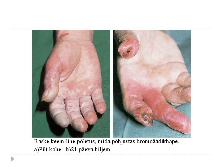 Raske keemiline põletus, mida põhjustas bromoäädikhape. a)Pilt kohe b)21 päeva hiljem 