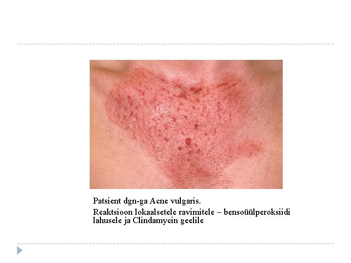 Patsient dgn-ga Acne vulgaris. Reaktsioon lokaalsetele ravimitele – bensoüülperoksiidi lahusele ja Clindamycin geelile 