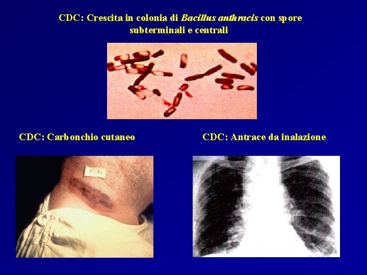 CDC: Crescita in colonia di Bacillus anthracis con spore subterminali e centrali CDC: Carbonchio