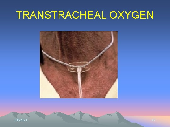 TRANSTRACHEAL OXYGEN 6/8/2021 47 