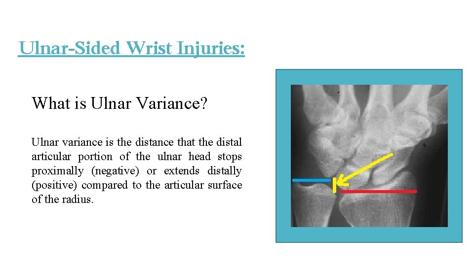 Ulnar-Sided Wrist Injuries: What is Ulnar Variance? Ulnar variance is the distance that the Ulnar-Sided Wrist Injuries: What is Ulnar Variance? Ulnar variance is the distance that the
