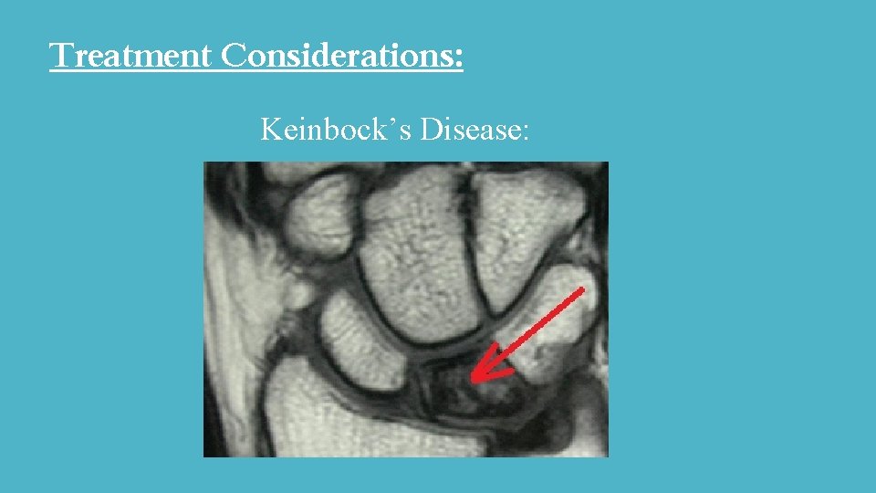 Treatment Considerations: Ulnar-Sided Wrist Injuries: Keinbock’s Disease: Treatment Considerations: Ulnar-Sided Wrist Injuries: Keinbock’s Disease:
