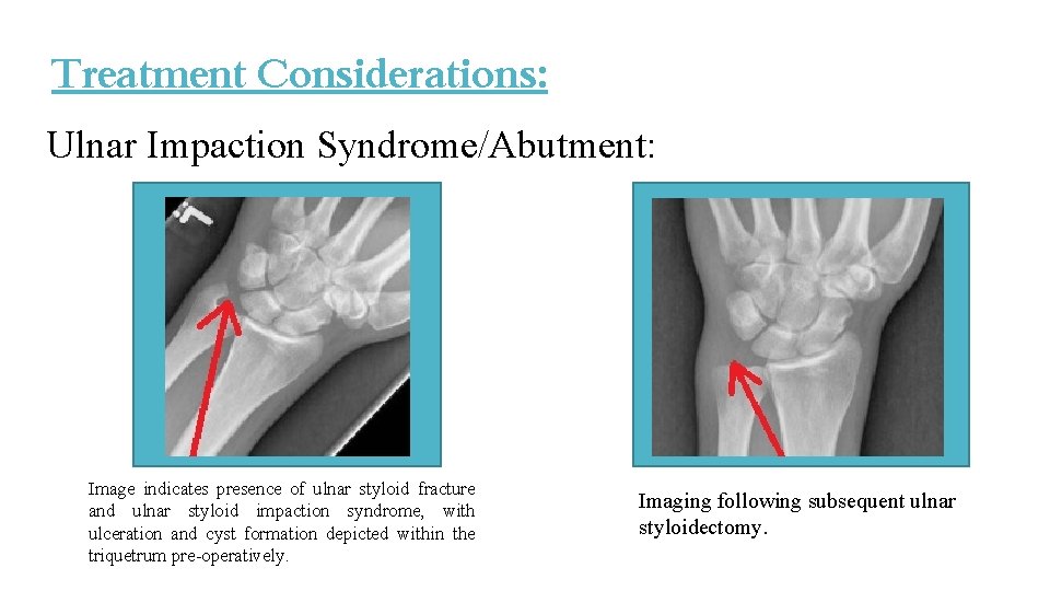 Treatment Considerations: Ulnar Impaction Syndrome/Abutment: Image indicates presence of ulnar styloid fracture and ulnar Treatment Considerations: Ulnar Impaction Syndrome/Abutment: Image indicates presence of ulnar styloid fracture and ulnar