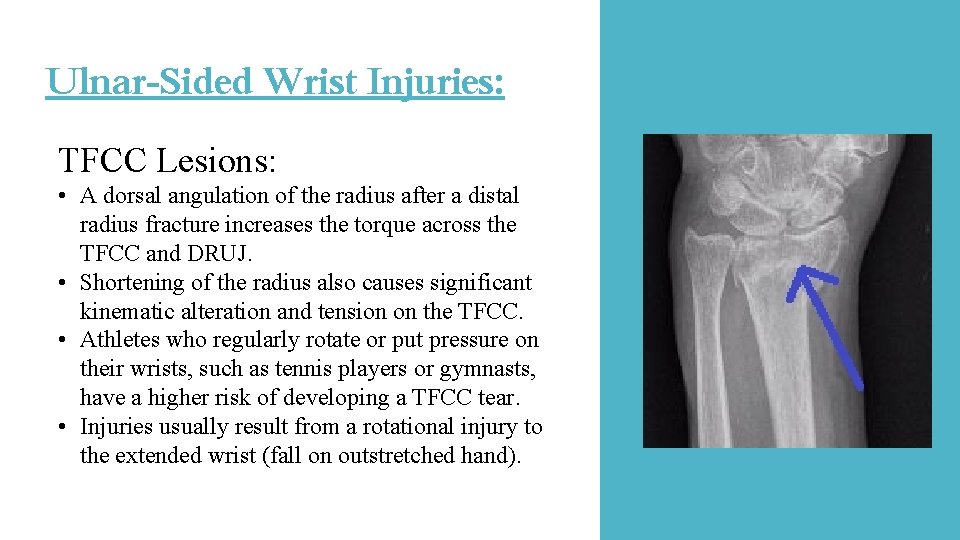 Ulnar-Sided Wrist Injuries: TFCC Lesions: • A dorsal angulation of the radius after a Ulnar-Sided Wrist Injuries: TFCC Lesions: • A dorsal angulation of the radius after a
