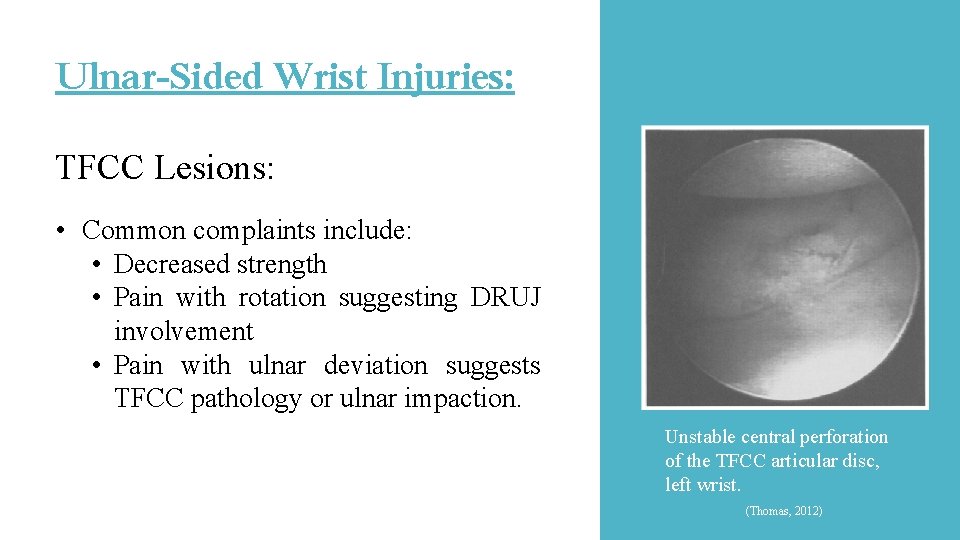 Ulnar-Sided Wrist Injuries: TFCC Lesions: • Common complaints include: • Decreased strength • Pain Ulnar-Sided Wrist Injuries: TFCC Lesions: • Common complaints include: • Decreased strength • Pain