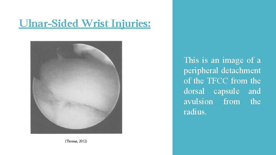 Ulnar-Sided Wrist Injuries: This is an image of a peripheral detachment of the TFCC Ulnar-Sided Wrist Injuries: This is an image of a peripheral detachment of the TFCC