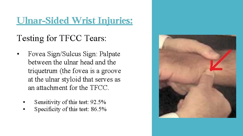 Ulnar-Sided Wrist Injuries: Testing for TFCC Tears: • Fovea Sign/Sulcus Sign: Palpate between the Ulnar-Sided Wrist Injuries: Testing for TFCC Tears: • Fovea Sign/Sulcus Sign: Palpate between the