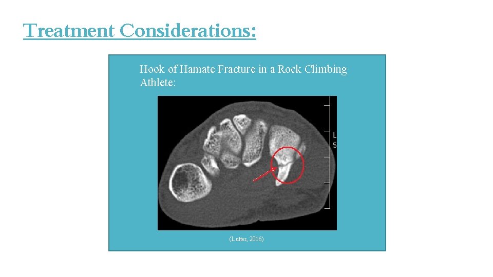 Treatment Considerations: Hook of Hamate Fracture in a Rock Climbing Athlete: (Lutter, 2016) Treatment Considerations: Hook of Hamate Fracture in a Rock Climbing Athlete: (Lutter, 2016)