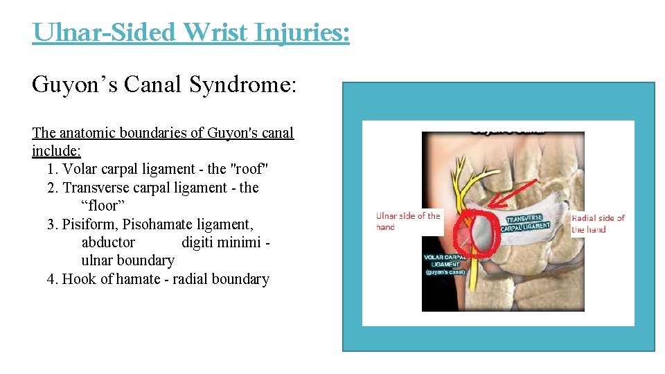 Ulnar-Sided Wrist Injuries: Guyon’s Canal Syndrome: The anatomic boundaries of Guyon's canal include: 1. Ulnar-Sided Wrist Injuries: Guyon’s Canal Syndrome: The anatomic boundaries of Guyon's canal include: 1.
