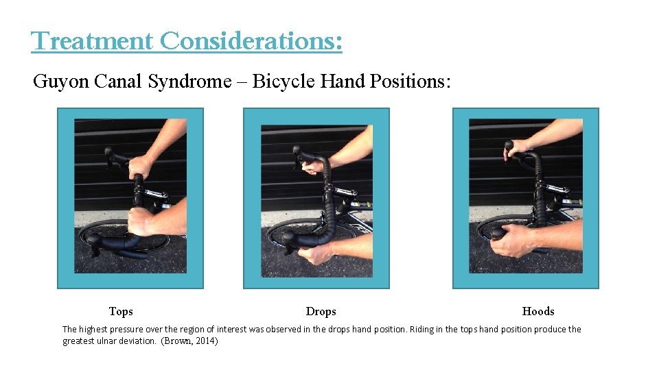 Treatment Considerations: Guyon Canal Syndrome – Bicycle Hand Positions: Tops Drops Hoods The highest Treatment Considerations: Guyon Canal Syndrome – Bicycle Hand Positions: Tops Drops Hoods The highest