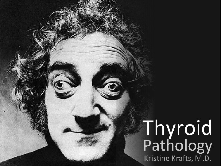 Thyroid Pathology Kristine Krafts, M. D. Thyroid Pathology Kristine Krafts, M. D.
