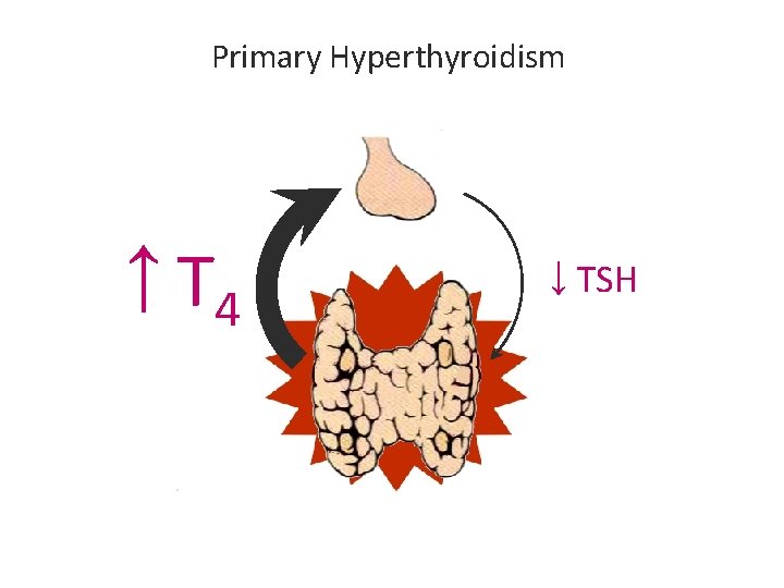 Primary Hyperthyroidism ↑ T 4 ↓ TSH Primary Hyperthyroidism ↑ T 4 ↓ TSH