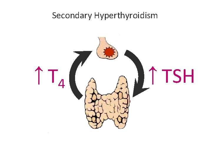Secondary Hyperthyroidism ↑ T 4 ↑ TSH Secondary Hyperthyroidism ↑ T 4 ↑ TSH