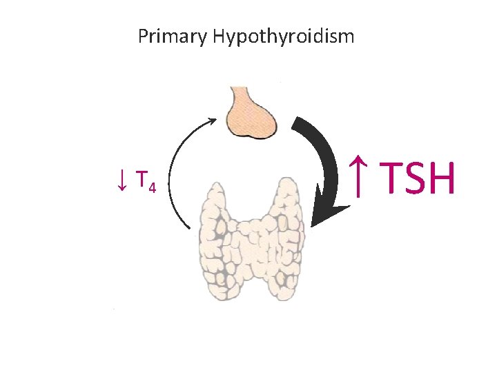 Primary Hypothyroidism ↓ T 4 ↑ TSH Primary Hypothyroidism ↓ T 4 ↑ TSH