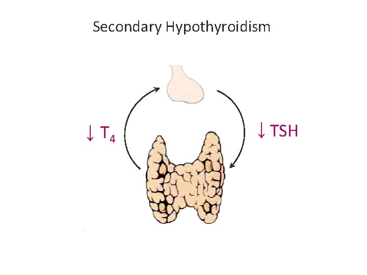 Secondary Hypothyroidism ↓ T 4 ↓ TSH Secondary Hypothyroidism ↓ T 4 ↓ TSH